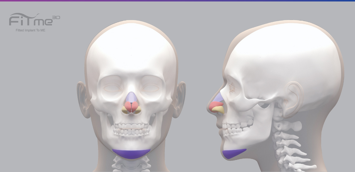 FIT ME custom made silicone implants – Chin Implant Silicone | KEOSAN